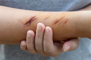 Tế bào NK làm trung gian cho sự cân bằng giữa chữa lành vết thương và bảo vệ vi khuẩn